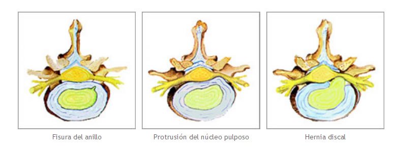 hernia discal y protusion