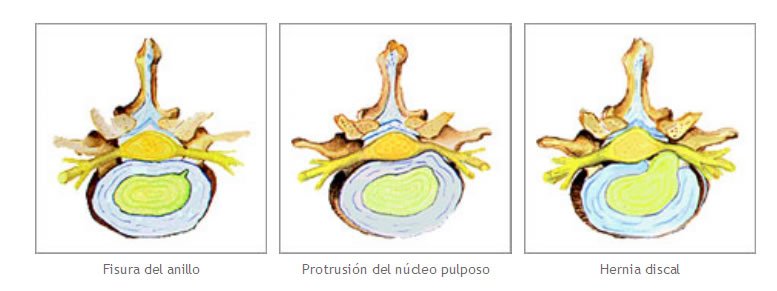 hernia discal y protusion