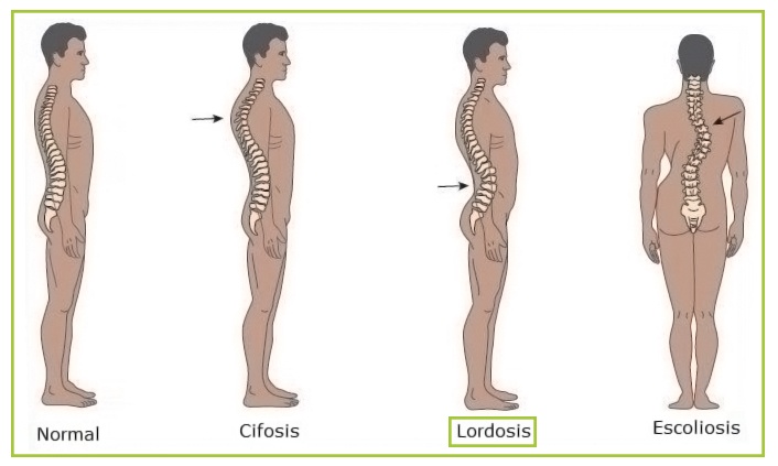 lordosis cervical